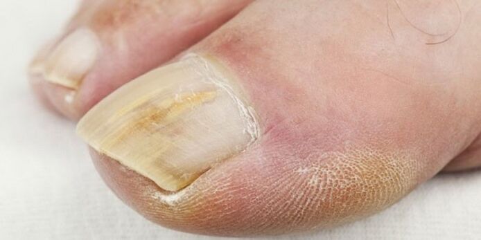 sintomas de fungo nas unhas