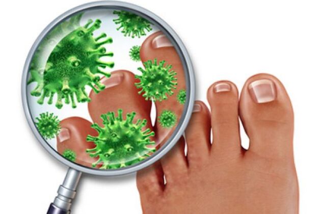 infecção fúngica nas unhas dos pés