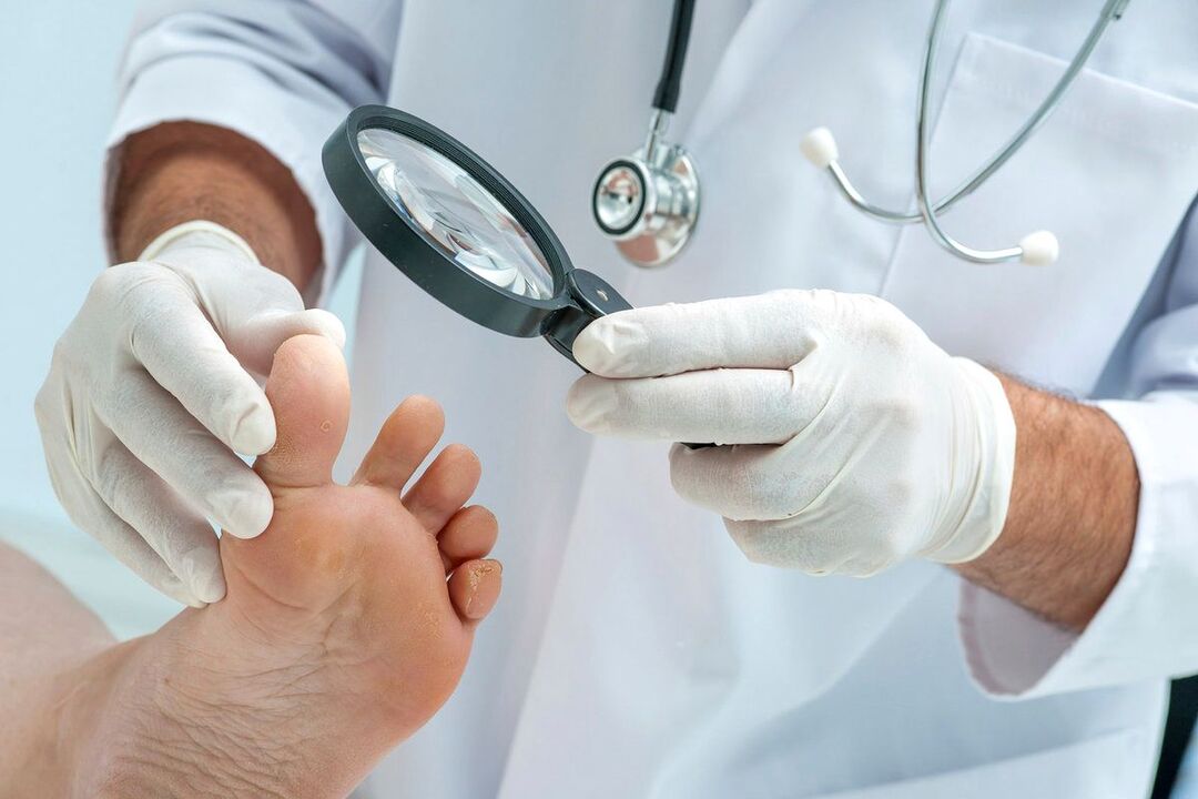 médico examina pés com fungos