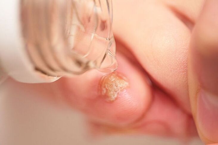 tratamento de fungos nas unhas com vinagre