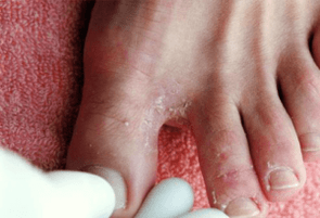 sintomas de fungos nos pés