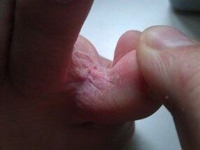 lesões de pele entre os dedos dos pés com um fungo