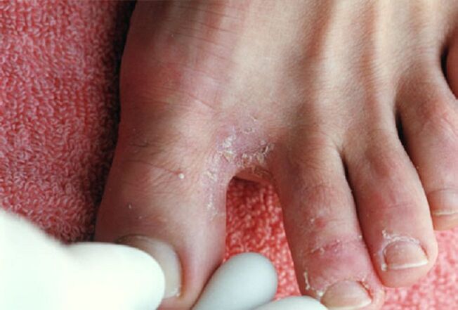 Manifestações de fungos intertriginosos entre os dedos dos pés