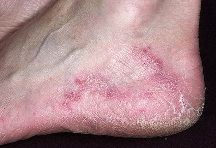 Rachaduras e vermelhidão na pele dos calcanhares são sinais de infecção fúngica
