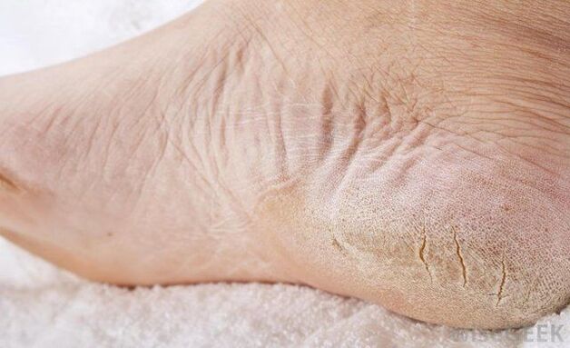 pés secos é sinal de fungo