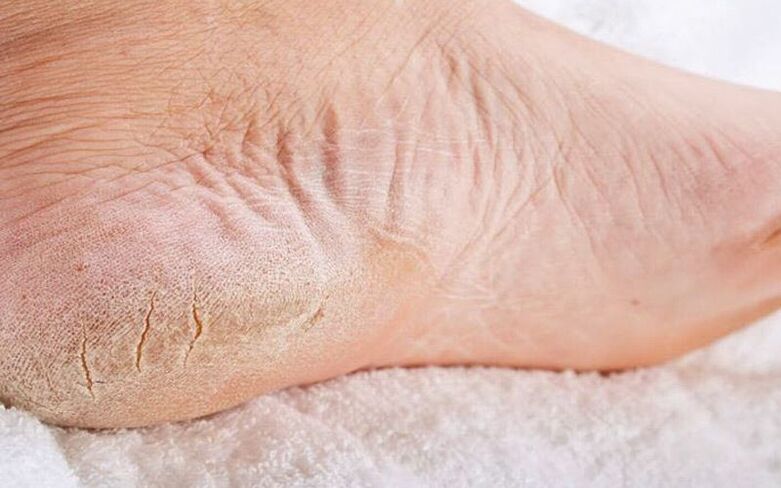 sintomas de fungo nos pés