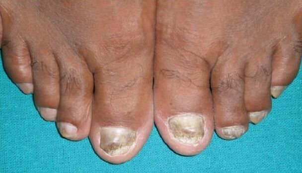 Fungo nas unhas