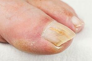 Terreno -finger