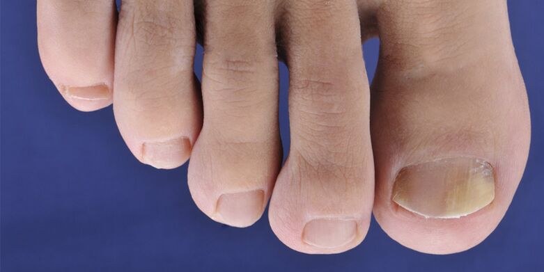 Sintomas de micose da pele e placas de unhas