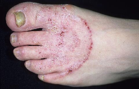Pés e fungos de unhas
