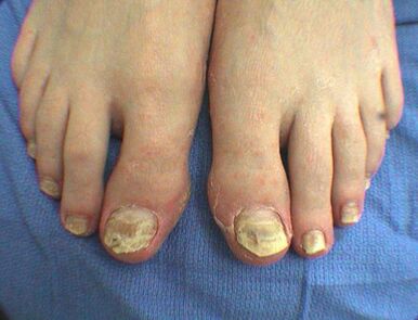 Sintomas de fungo das unhas