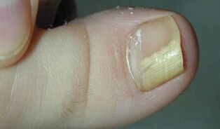 Sinais e sintomas de fungo das unhas