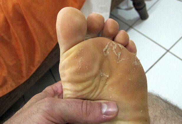 fungo na pele das pernas
