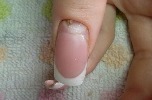 sintomas de fungos nas unhas