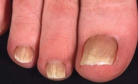 tipo de fungo nas unhas