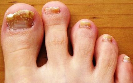 unhas dos pés afetadas por fungos