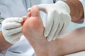 médico examina pés em busca de fungos nos dedos dos pés