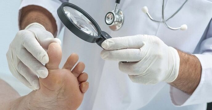 o médico examina os pés em busca de fungos nas unhas
