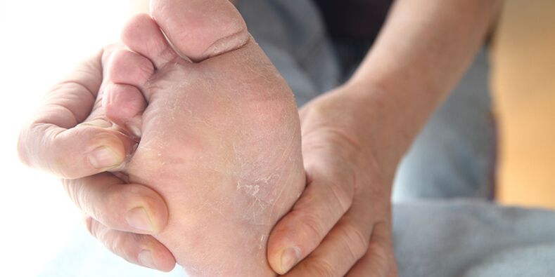 lesões de pele com fungos nas pernas