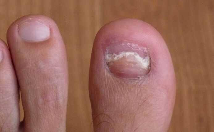 danos na unha do dedão do pé com um fungo