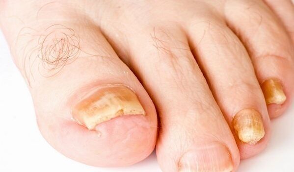 foto de sintomas de fungo nas unhas dos pés