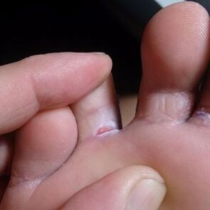 rachadura entre os dedos dos pés sintomas de fungo